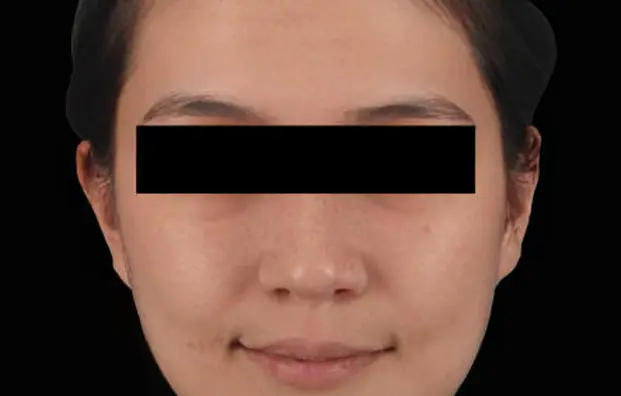 Asian Model 3 Before