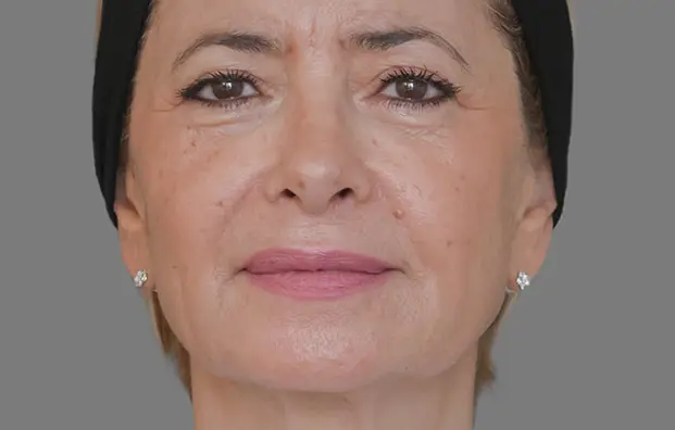 Après