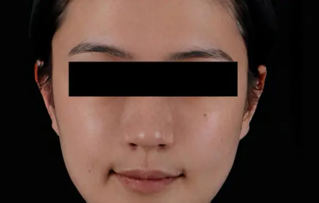 Asian Model 3 AFTER 12 MONTH