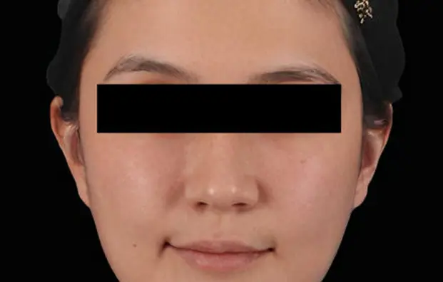 Asian Model 3 Immediate After